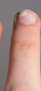 Why Do My Nails Have White Spots