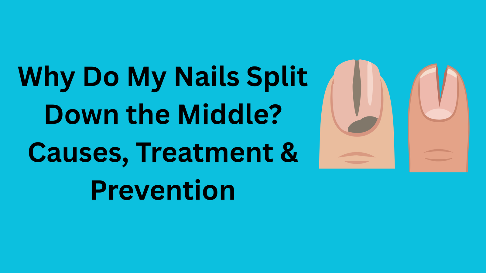Why Do My Nails Split Down the Middle? Causes, Treatment & Prevention